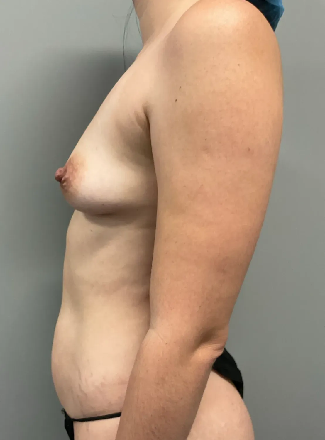 Breast Augmentation Before & After