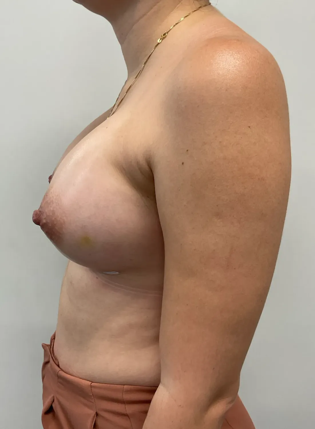 Breast Augmentation Before & After